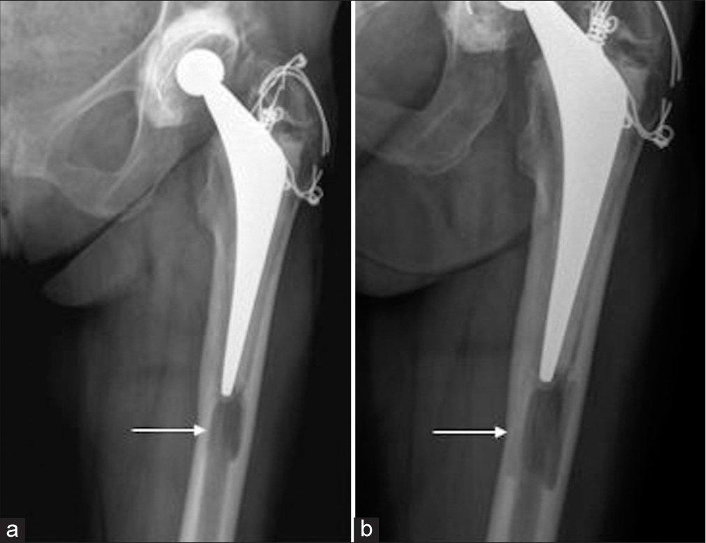 Osteolytic change surrounding biodegradable cement restrictors used in total hip replacements mimicking malignancy