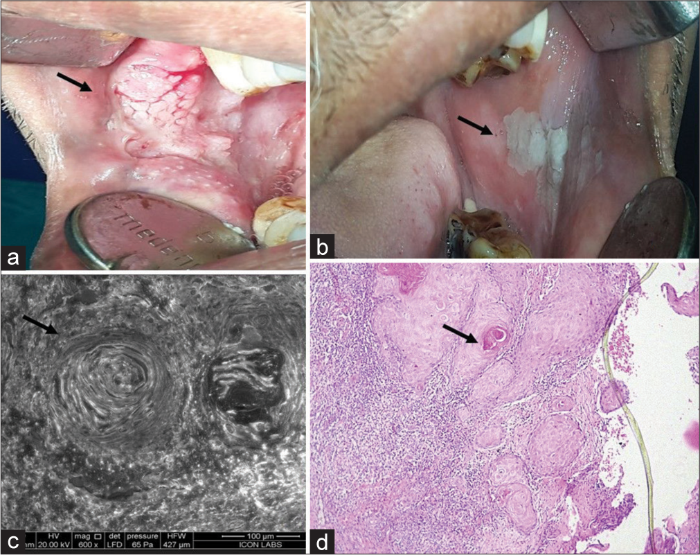 Oral squamous cell carcinoma: A case report with scanning electron microscopy, Mallory’s, Masson’s trichrome, orcein, and Papanicolaou staining
