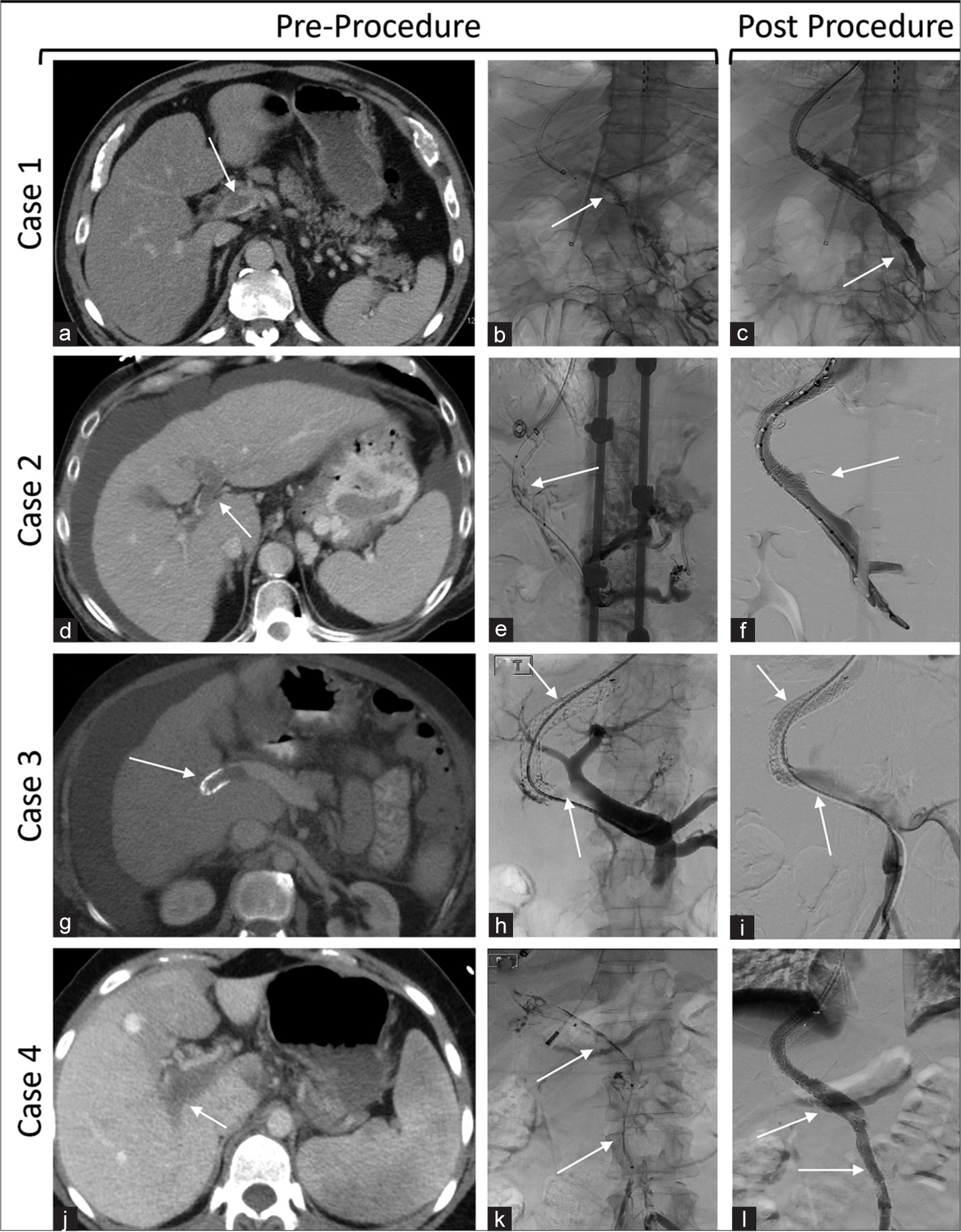 Mechanical thrombectomy with the novel InThrill thrombectomy catheter for portal vein thrombosis and occluded transjugular intrahepatic portosystemic shunt: A case series