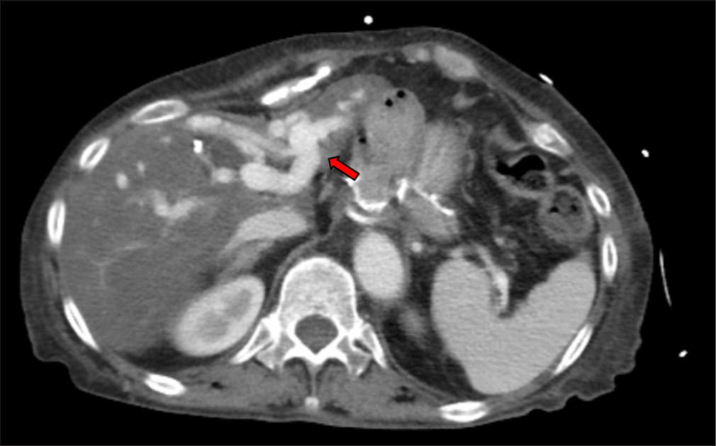 Successful embolization of symptomatic intrahepatic portosystemic venous shunts through trans-splenic access – A case report