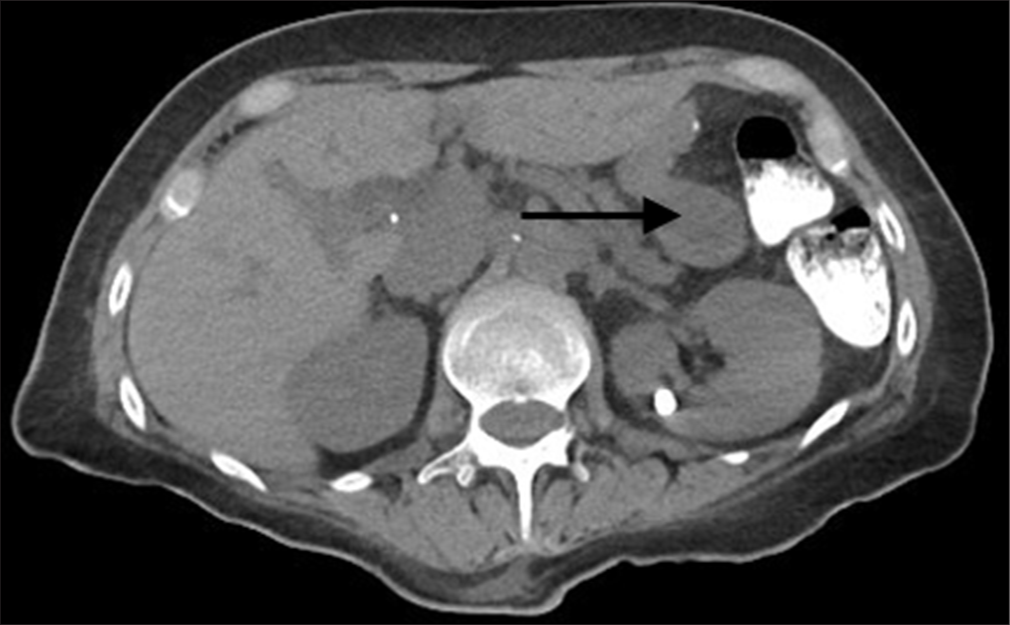 Insufflation of the gastric remnant from a transduodenal approach facilitates percutaneous gastrostomy tube placement in a post Roux-en-Y patient