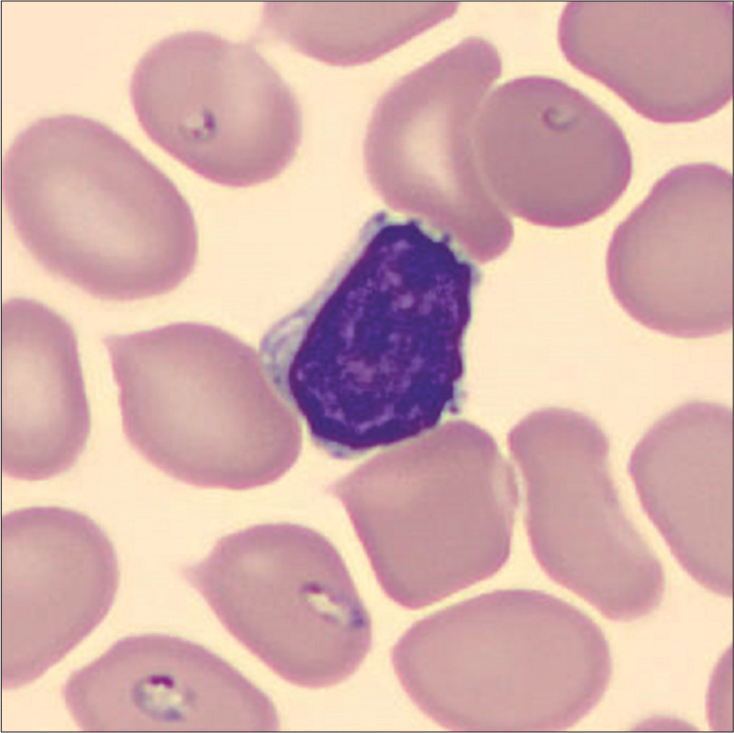 Babesiosis unmasked in chronic lymphocytic leukemia: A case report