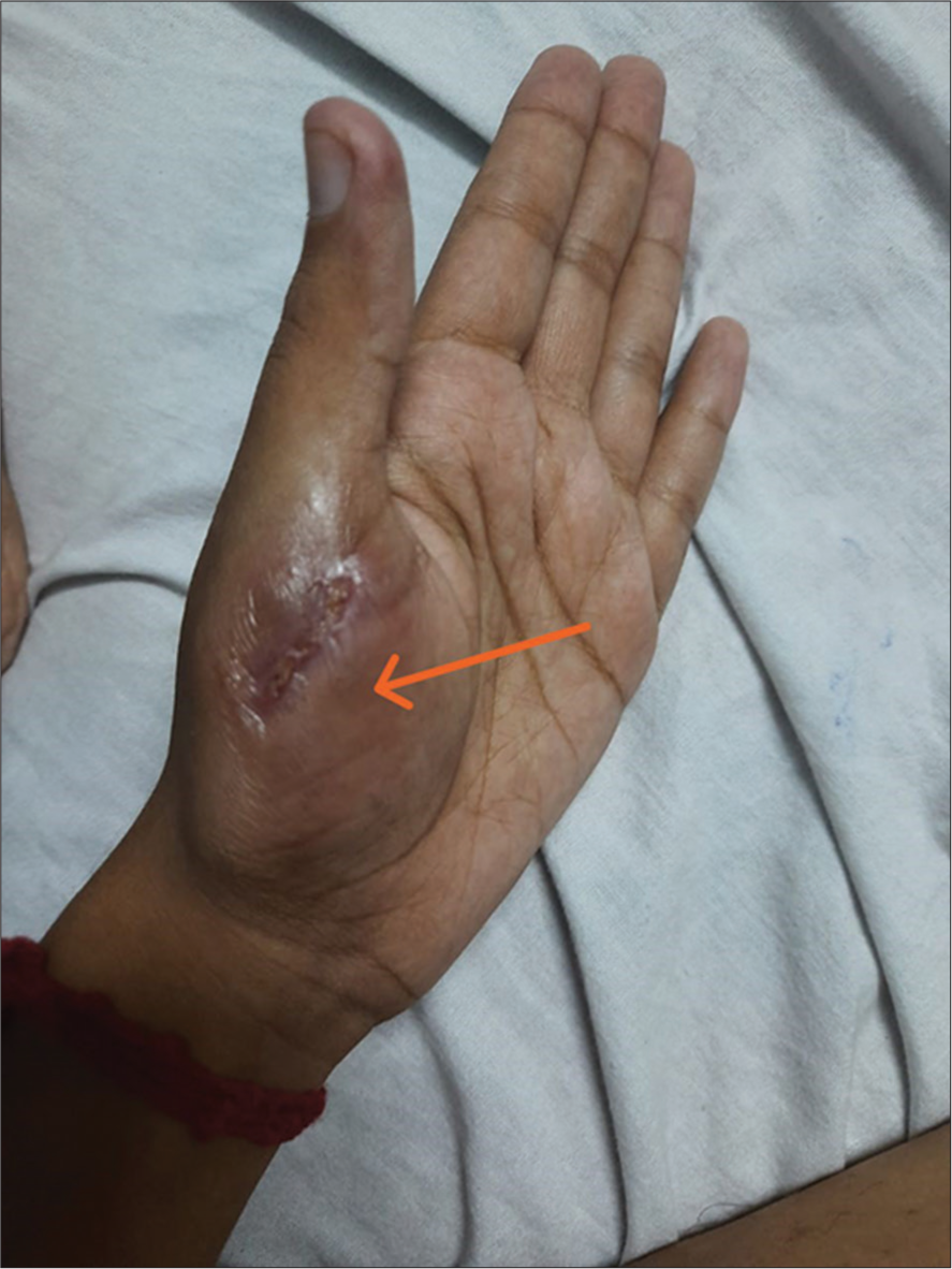 Multisite cutaneous tuberculosis in an immunocompetent patient – A mysterious presentation of yet common disease