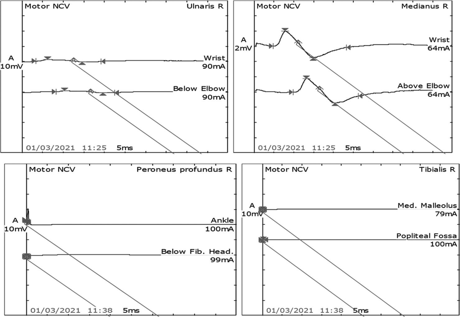 A case of atypical complication of severe leptospirosis as Guillain-Barre syndrome