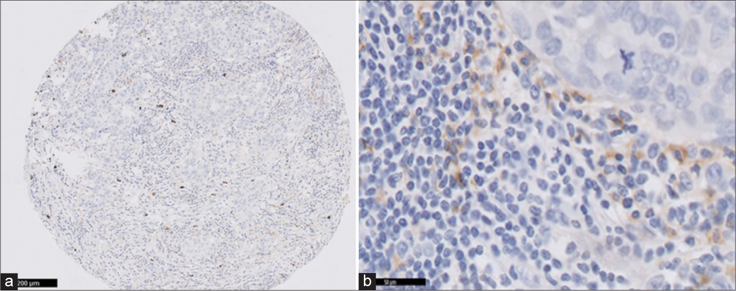 Prognostic significance of programmed death ligand 2 expression in tumor-infiltrating lymphocytes of triple-negative breast cancer