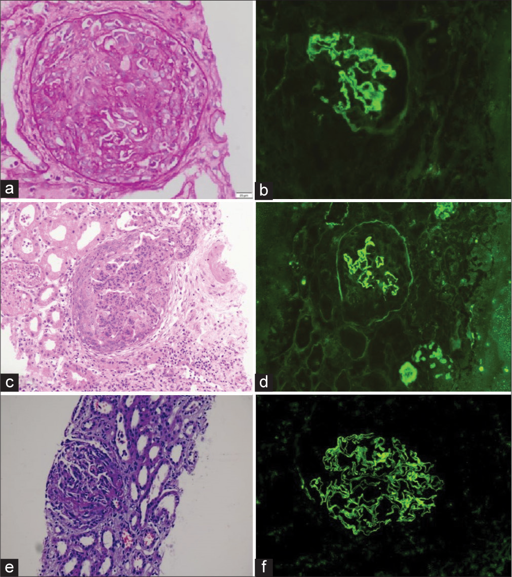 Goodpasture’s syndrome: A case series of unusual presentations including in a pregnancy