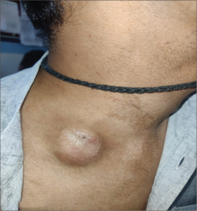 Co-infection with Mycobacterium and 20% acid-fast Nocardia in an immunocompetent patient – A case report