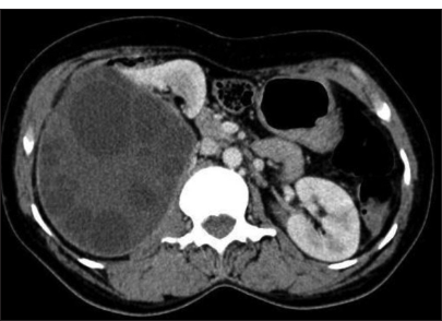 Imaging features of hydatid cyst in unusual locations: A case series