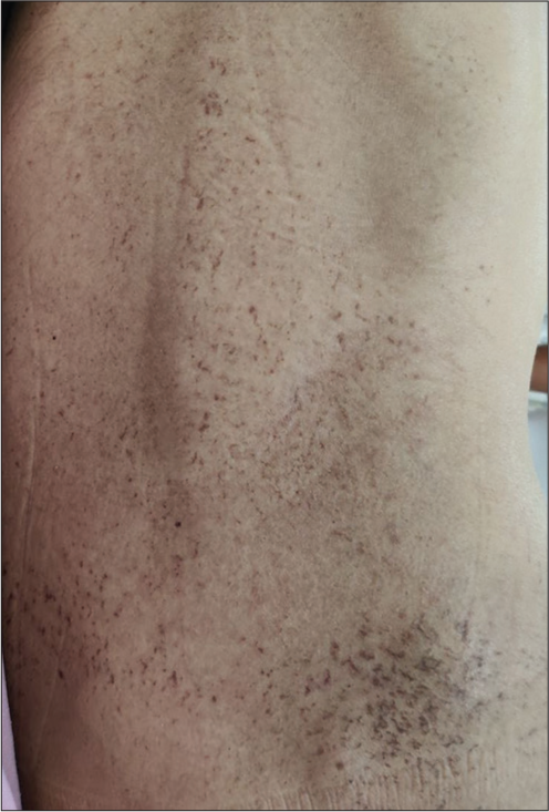 Flaky paint dermatosis in two adult patients of malnutrition