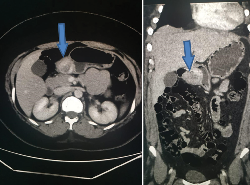 Rare presentation of gastric glomus tumor in a 28-year-old female with gastritis