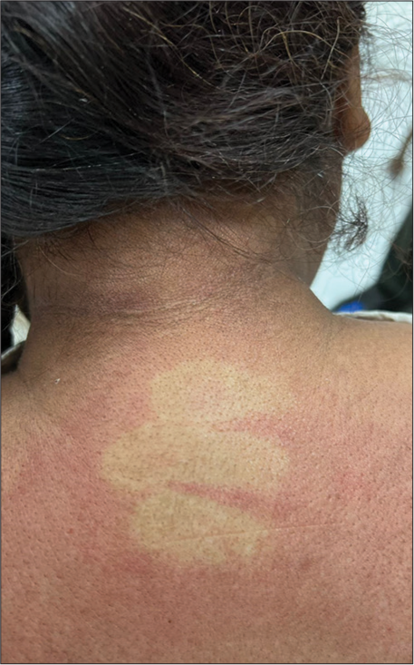 Anti-transcription intermediary factor 1 gamma antibody-associated paraneoplastic dermatomyositis: A case report