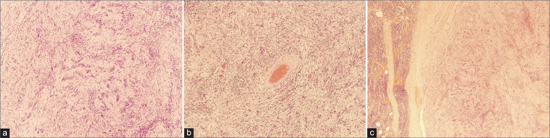 An unusual case of rectal schwannoma: A case report