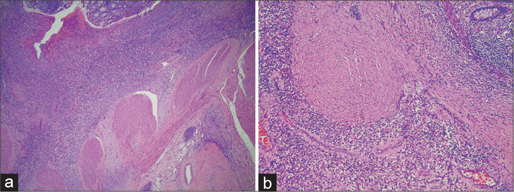 Florid vascular proliferation due to focal necrotizing enterocolitis in infancy: A case report