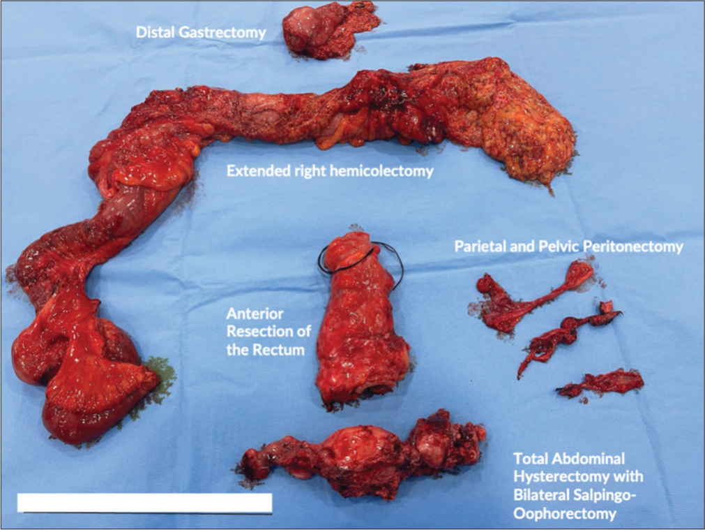 Integration of hyperthermic intraperitoneal chemotherapy with cytoreductive surgery for ovarian cancer in Iraq: Navigating challenges in a resource-limited setting