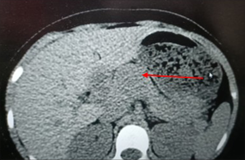 “Two tales of Frantz”: Varied presentations of solid pseudopapillary epithelial neoplasms of the pancreas