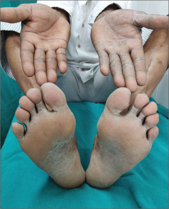 Two feet-one hand syndrome caused by Trichophyton mentagrophytes