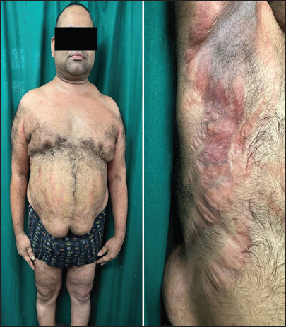 Iatrogenic Cushing’s syndrome, cataract, and metabolic syndrome in an adult following topical steroid abuse for dermatophytosis