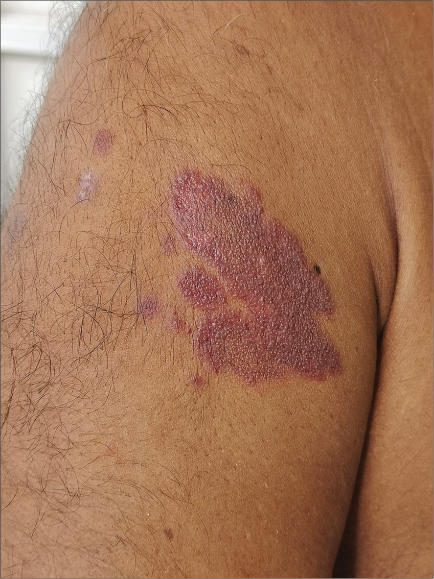 Eccrine angiomatous hamartoma – A rare painful skin tumor
