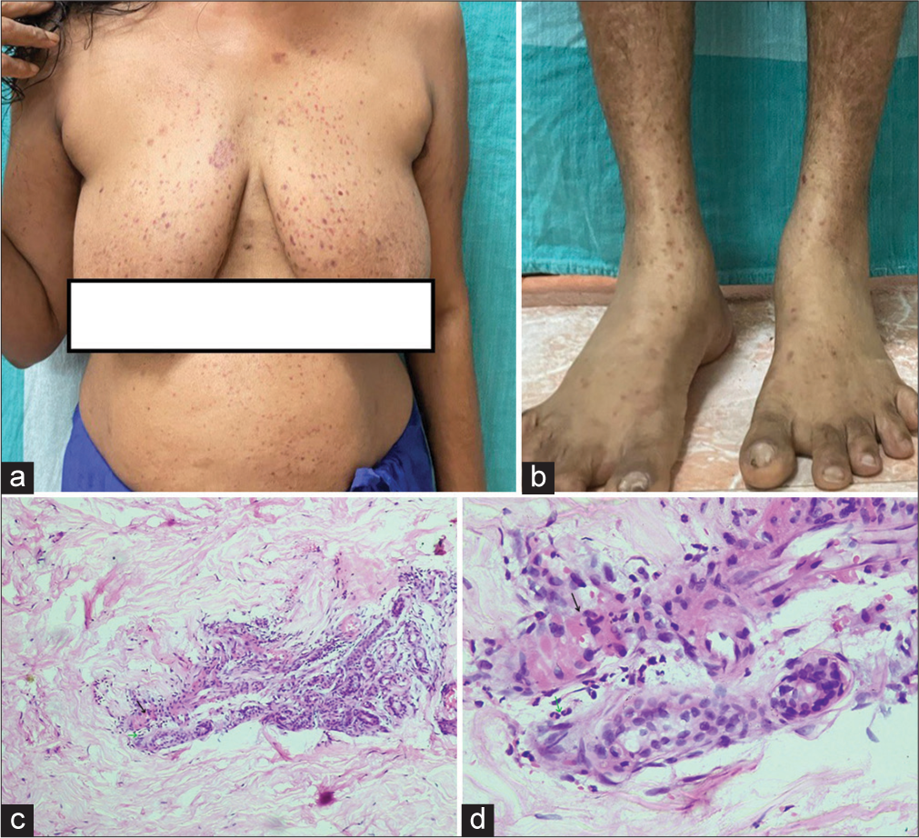 Rituximab-induced vasculitis: A rare occurrence