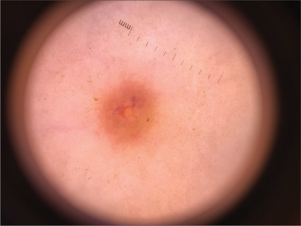 The use of topical rapamycin in successfully treating non-Langerhans cell histiocytosis in a pediatric patient