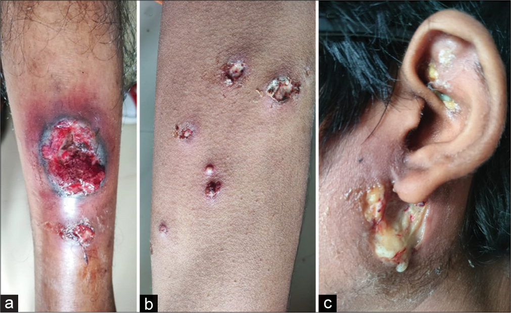 Pyoderma gangrenosum with Marfan syndrome and Crohn’s disease: A rare association