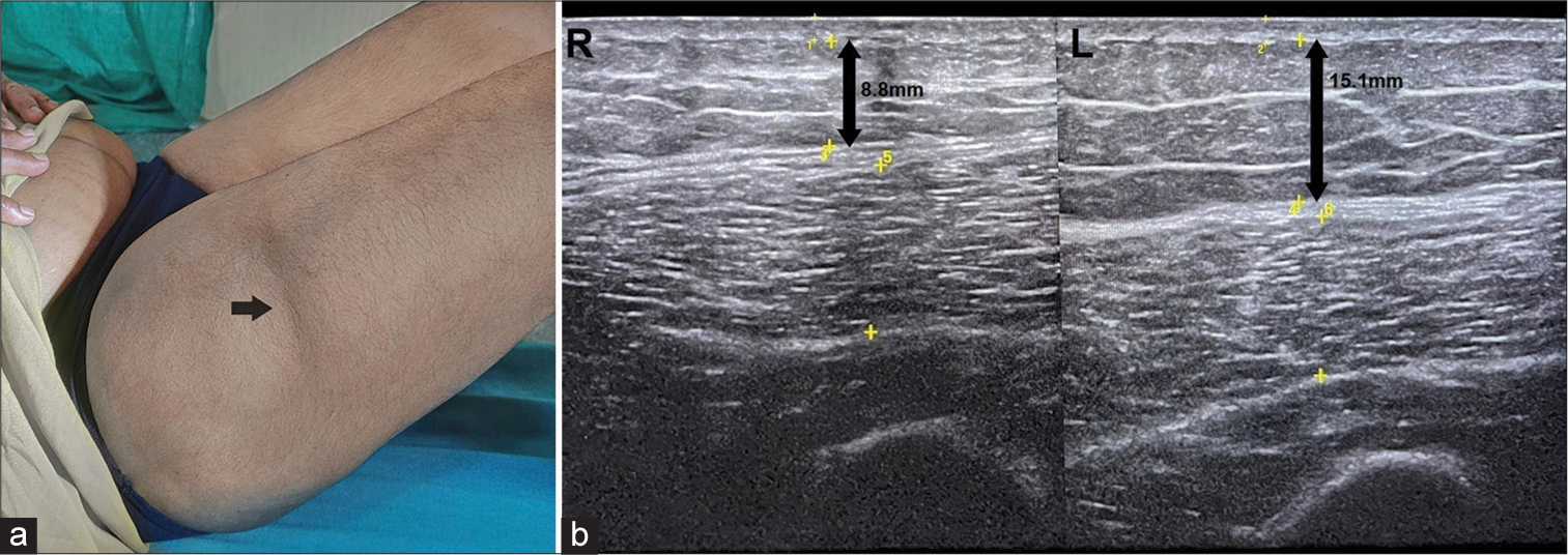 Semicircular lipoatrophy – An overlooked entity