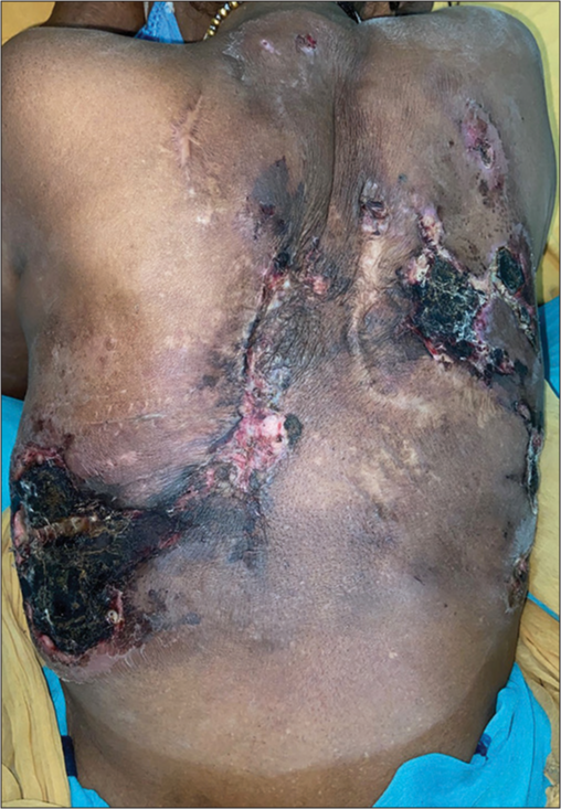 Atypical presentation of Basidiobolus as cutaneous ulceration