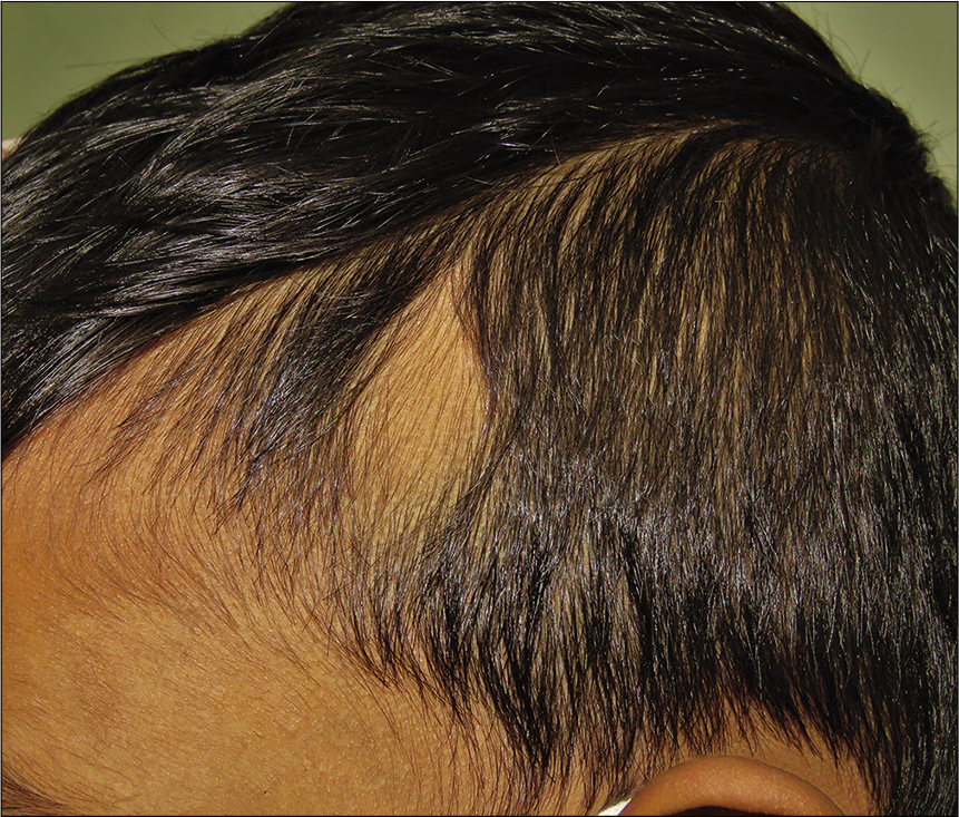 Congenital triangular alopecia