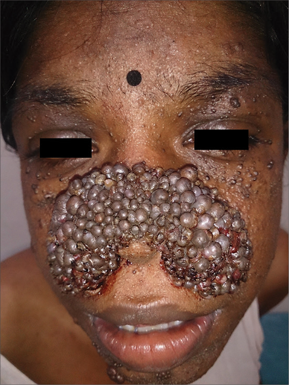 Extensive and exuberant angiofibromas producing breathing difficulty in a patient with tuberous sclerosis complex