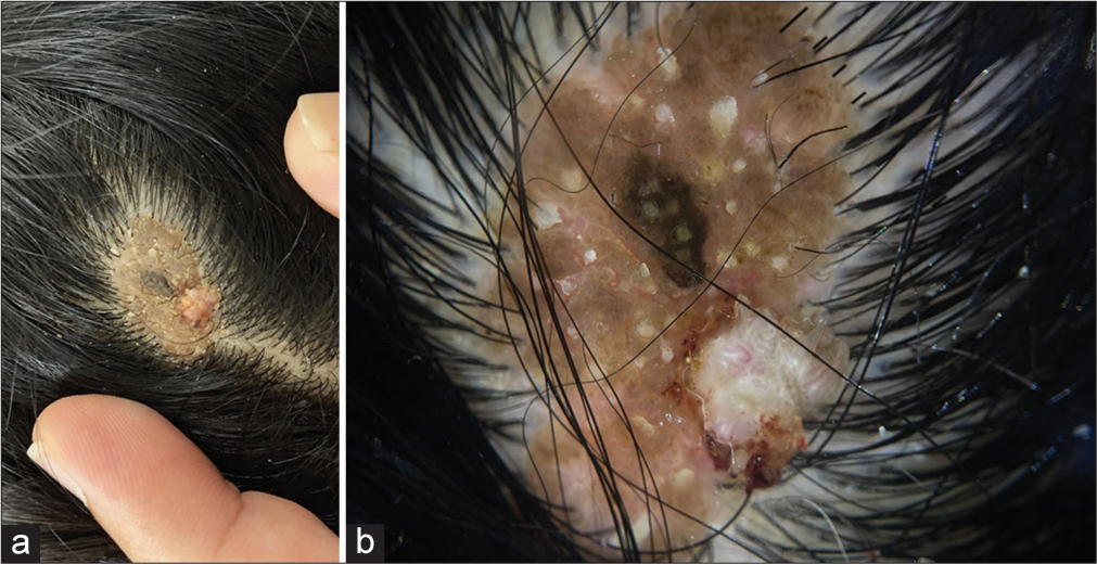 A rare example of locus minoris resistentiae