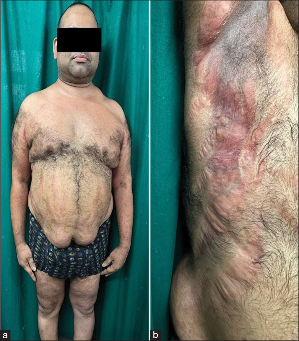 Iatrogenic Cushing’s syndrome, cataract, and metabolic syndrome in an adult following topical steroid abuse for dermatophytosis