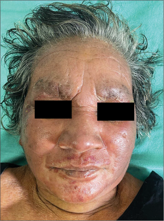 Photosensitive presentation of aggressive mycosis fungoides mimicking systemic lupus erythematosus