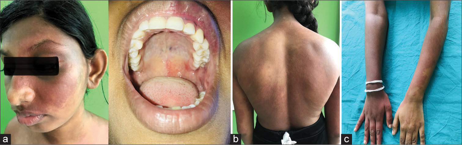 COVID-19 vaccine-induced pain over port wine stain in a patient with phakomatosis pigmentovascularis Type IIb and Sturge–Weber syndrome – A rare case report