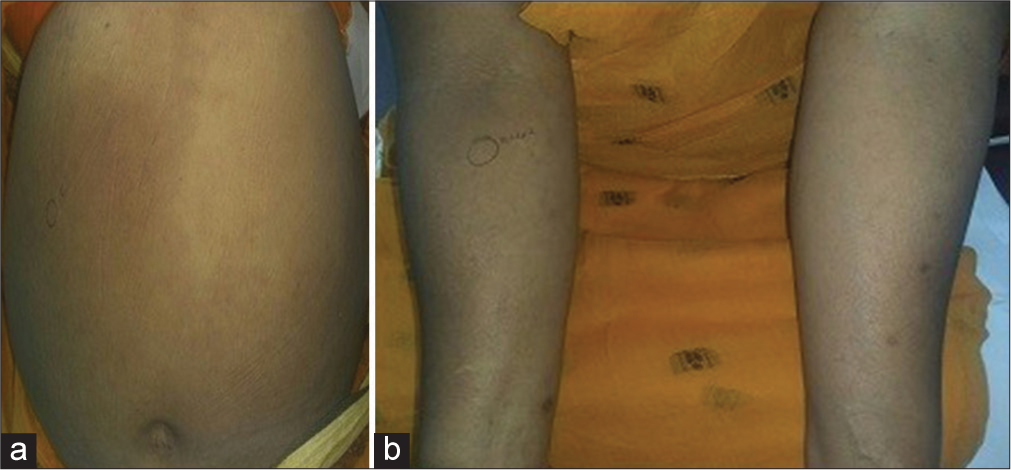 Ross syndrome: A rare and complex disorder of thermoregulation