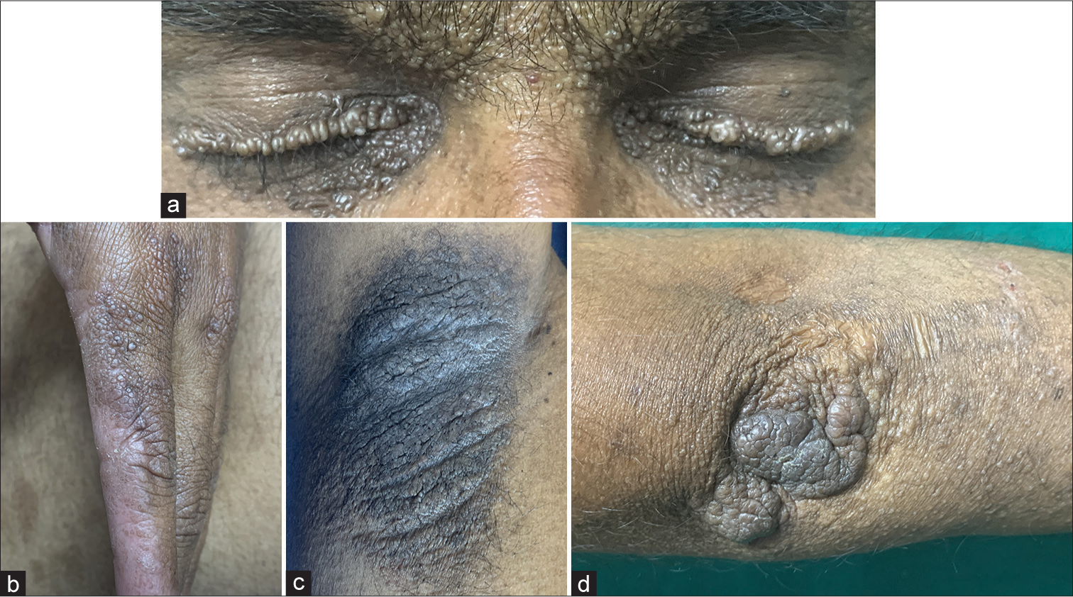 Dermoscopy of lipoid proteinosis – Topographic diverse features