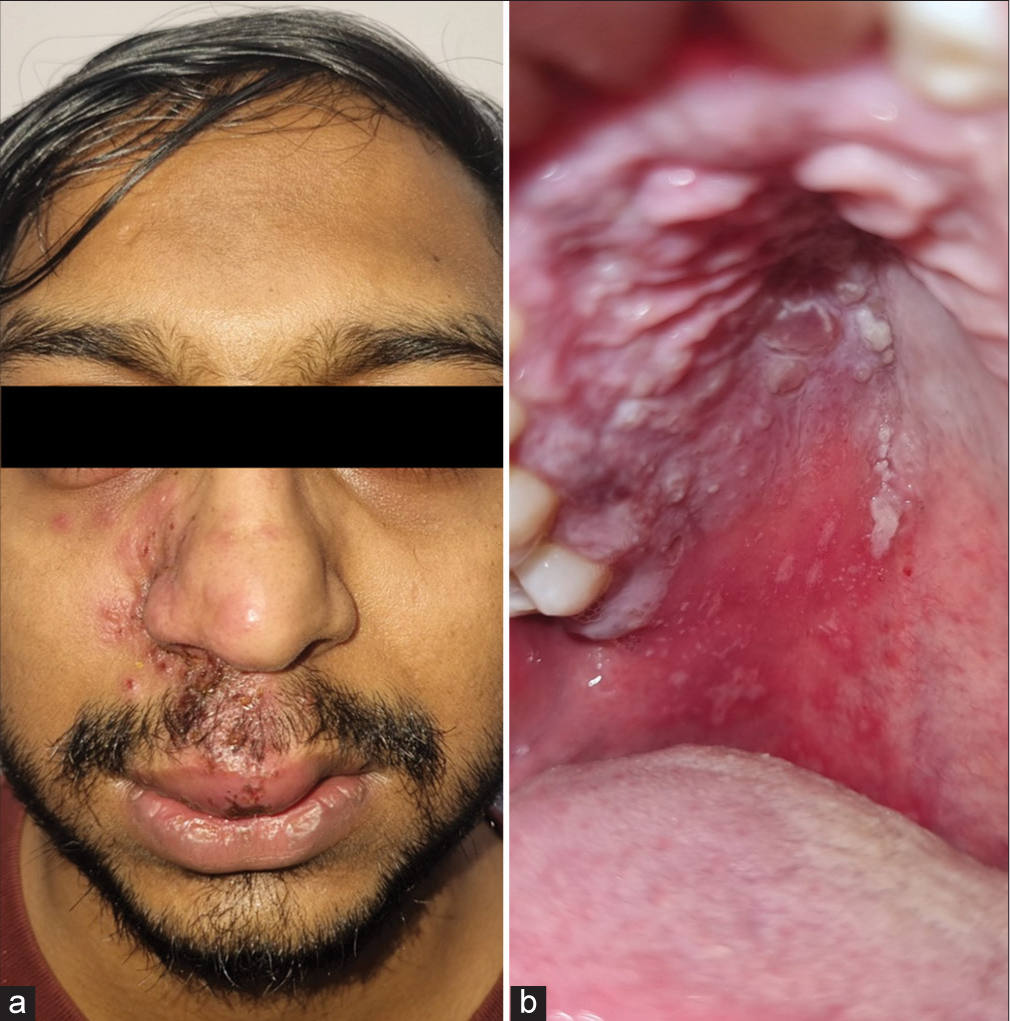 Herpes zoster maxillaris: Clinical, dermoscopic, and microscopic features