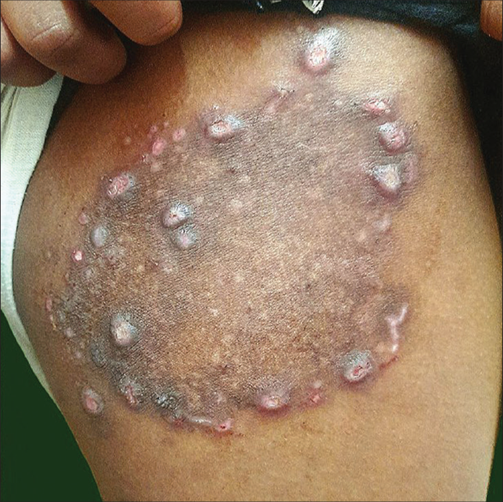 Majocchi’s granuloma following steroid application