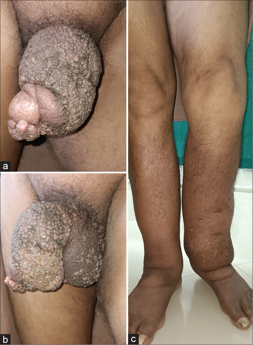 Saxophone penis with penoscrotal lymphangiomatosis secondary to lymphedema tarda
