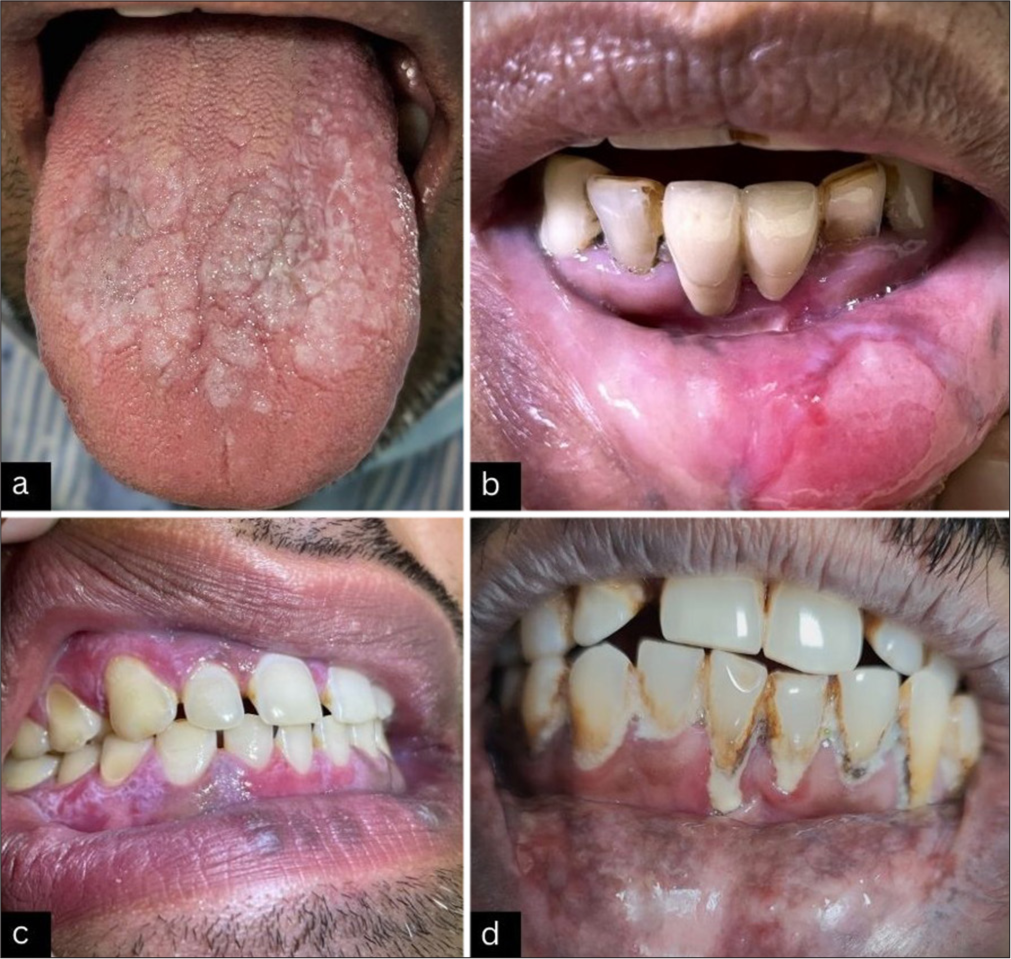 Oral lichen planus: Mucoscopic perspective