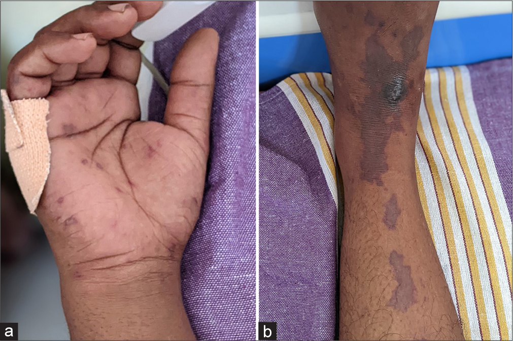 A rare case of purpura fulminans in an adult: Invasive meningococcal disease