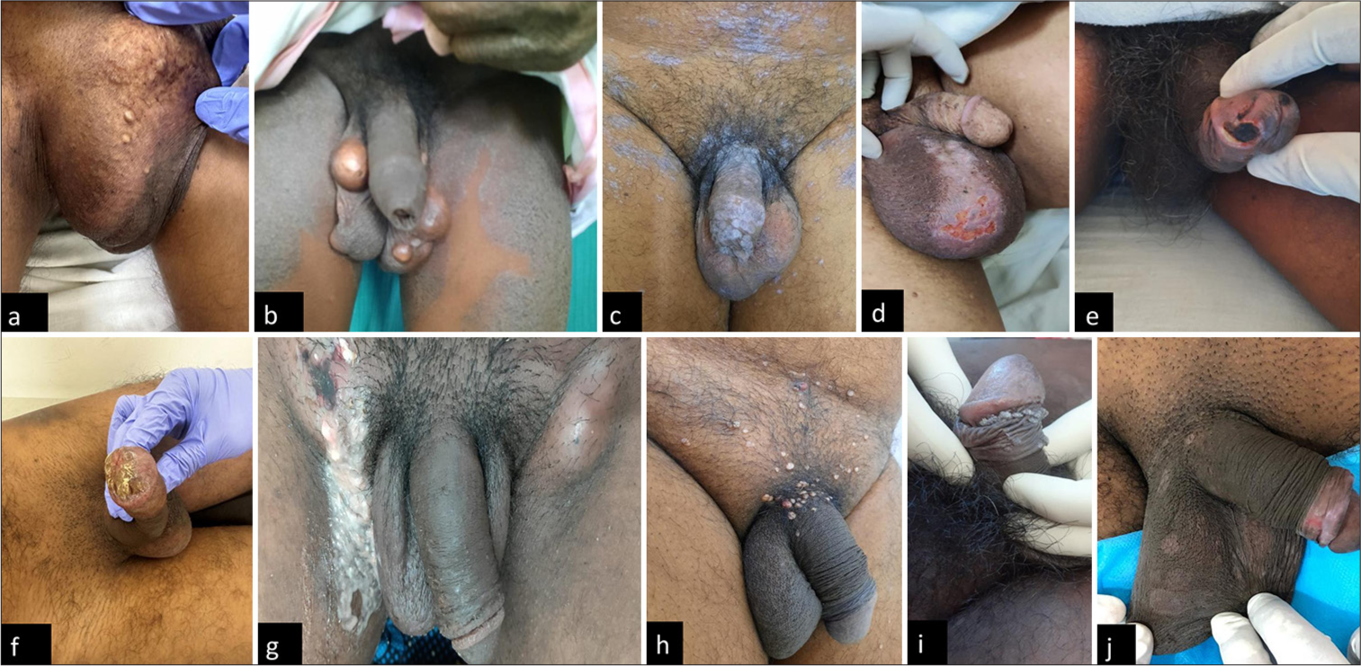 A descriptive study of patterns of genital dermatoses in patients in south India and evaluation of their quality-of-life