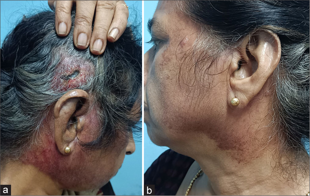Bilateral angiosarcoma: A rare occurrence