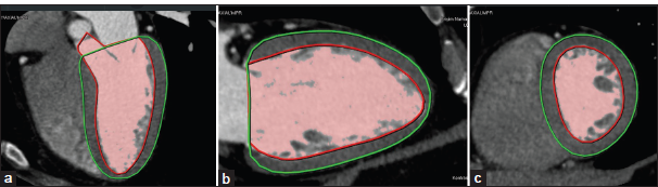 Normal human left ventricular mass, volume, and gender relationship by coronary computerized tomography angiography