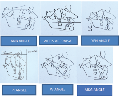 A comparison of the new parameter, “MKG angle” with ANB, Wits’ appraisal, Yen, Pi, and W angles