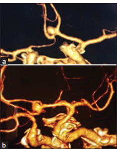 Anterior communicating artery aneurysm microsurgery resulted in a proximal pseudoaneurysm