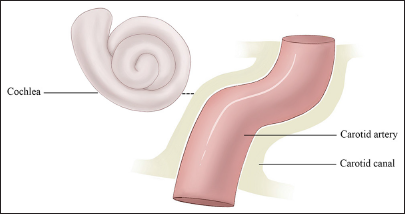 Why internal carotid artery pulsations are not audible?