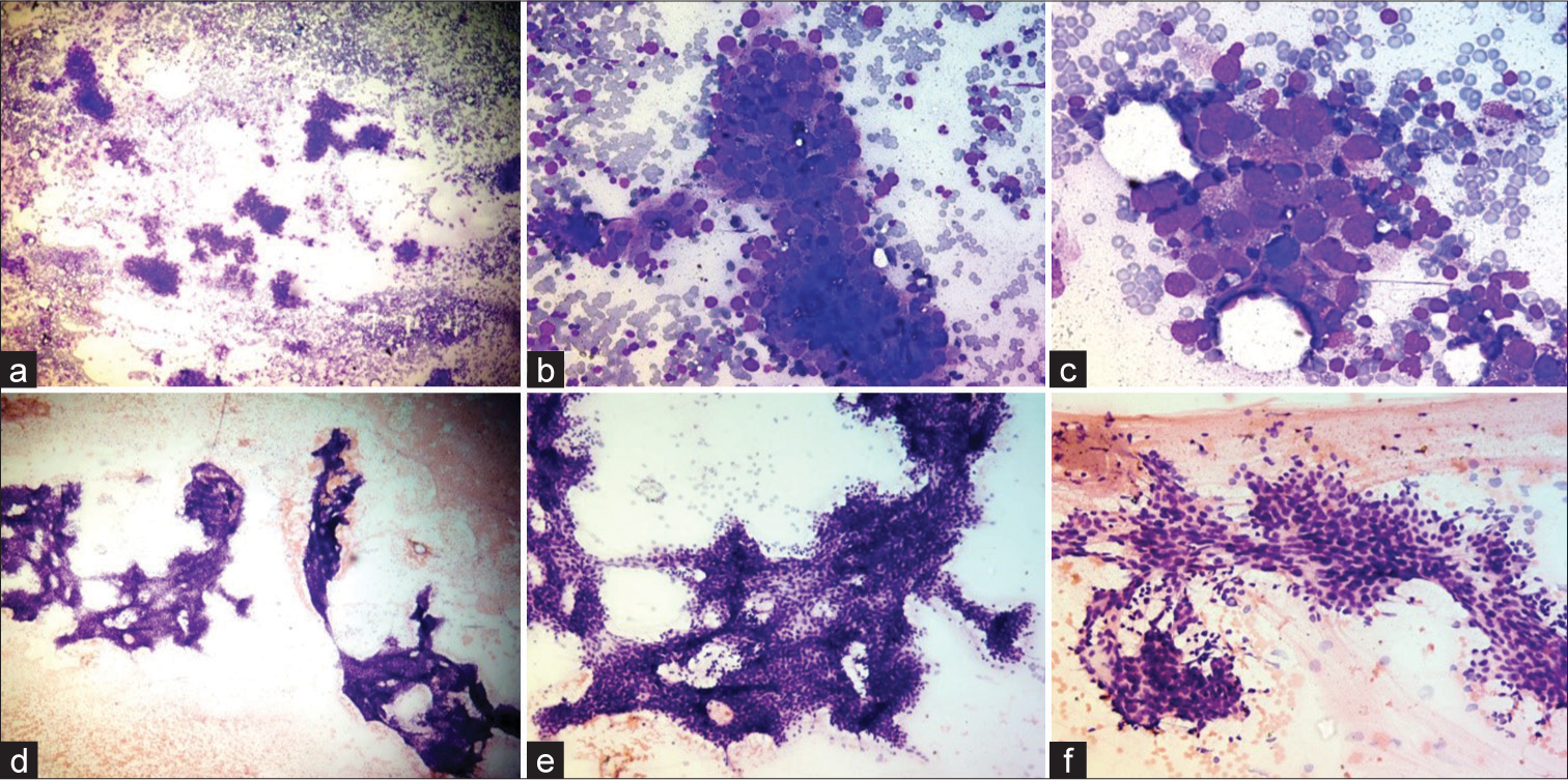 High-grade transformation in adenoid cystic carcinoma: Can it be diagnosed on cytology? A cytohistological correlation