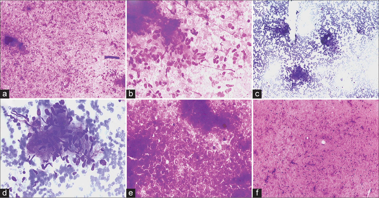 Cytomorphological findings in confirmed cases of tubercular lymphadenitis