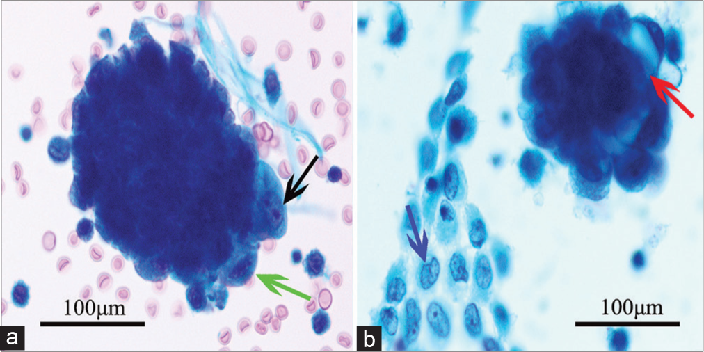Utility of immunocytochemistry in diagnosing abdominopelvic washings from patients undergoing radical surgery for endometrial cancer