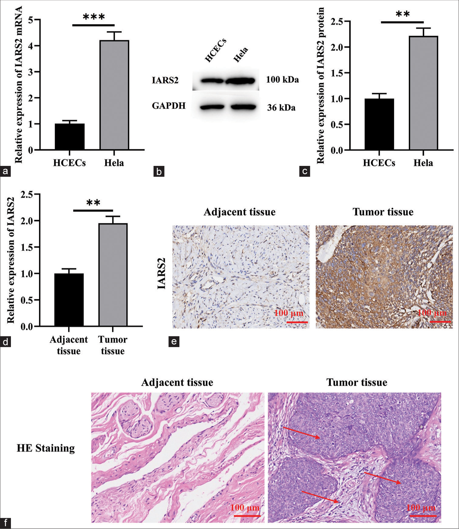 Mitochondrial protein isoleucyl-tRNA synthetase 2 in tumor cells as a potential therapeutic target for cervical cancer